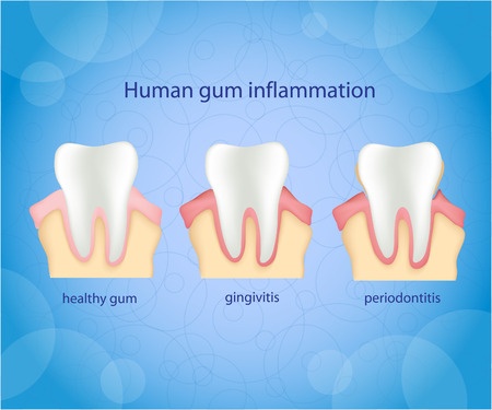 Gum disease