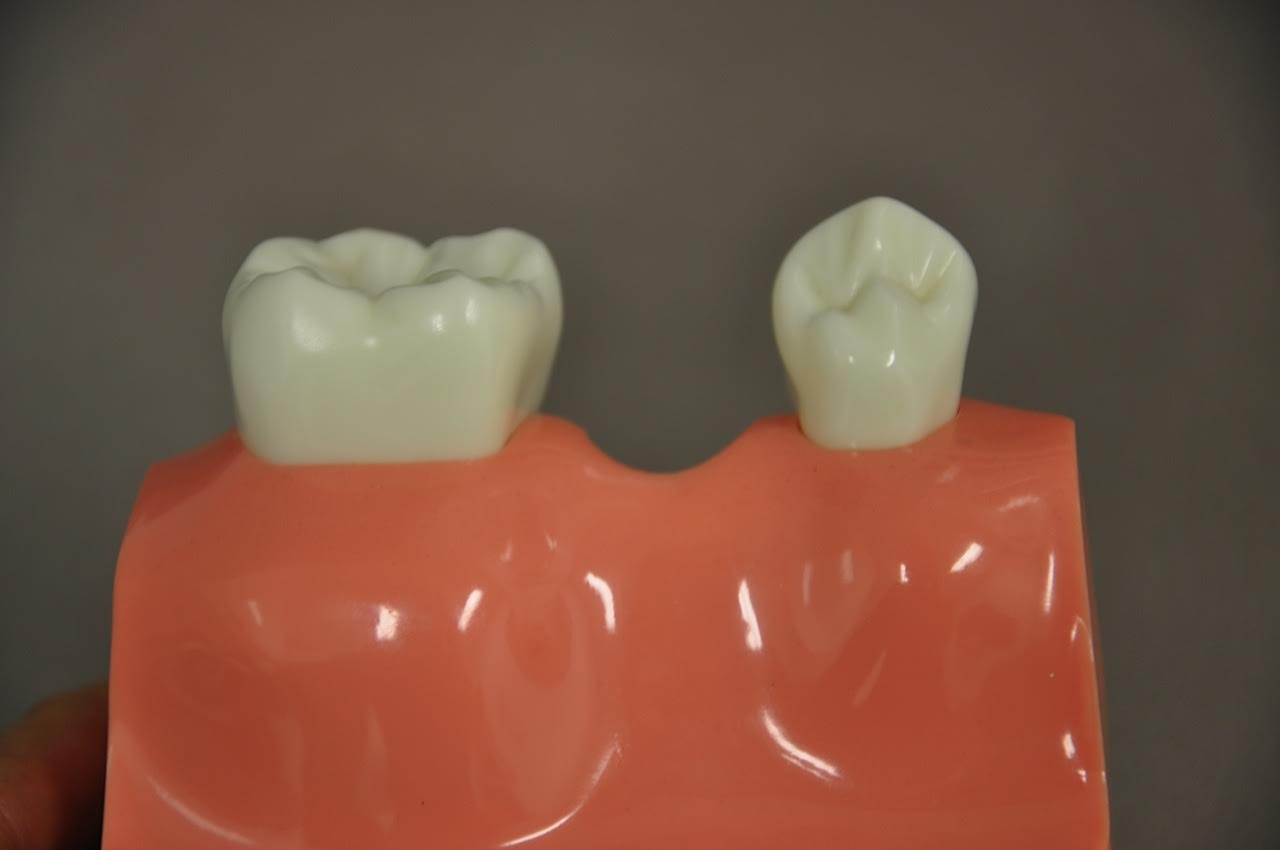 Dental Bridge Process