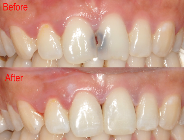 Before and After 5 Burpengary Dental