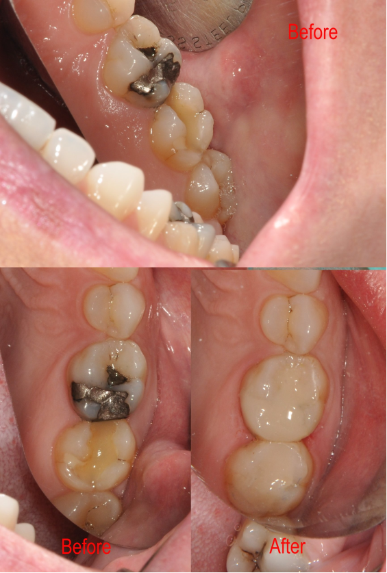 Before and after of dental work
