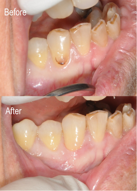 Before and after of dental work